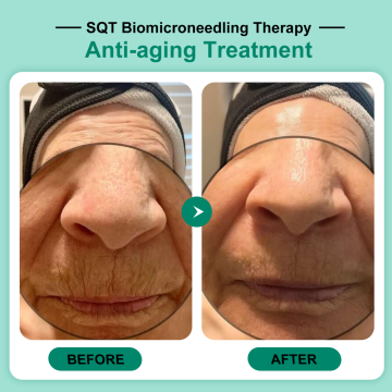 PROMĚNY: SQT Anti-Aging a výsledky v omlazení pleti (Fotogalerie)
